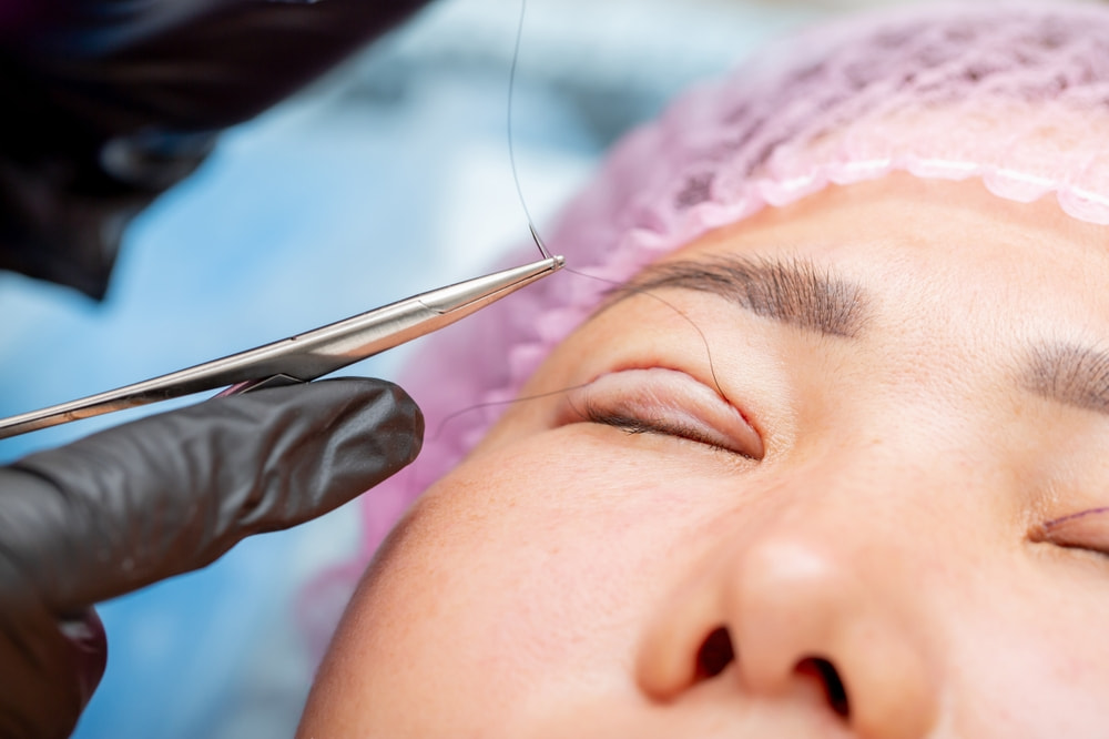 Profissional dando pontos em cicatriz de blefaroplastia.