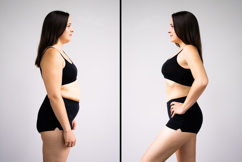 Imagem ilustrativa do antes e depois da abdominoplastia de uma mulher