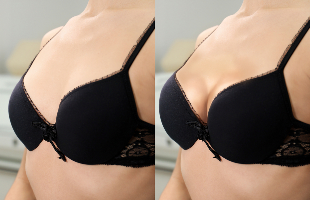 Fotos de antes e depois de uma mamoplastia.